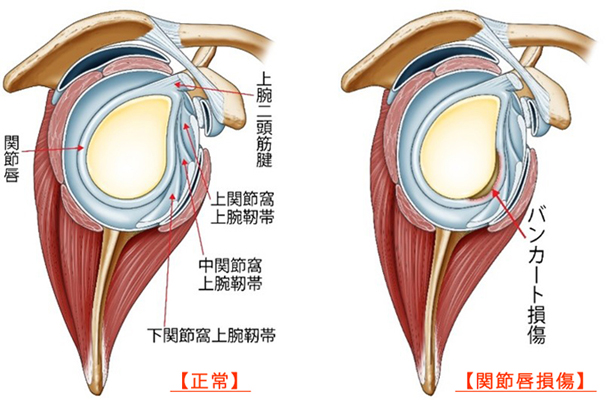 反復性肩関節脱臼の術式①