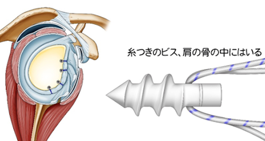 反復性肩関節脱臼の術式②