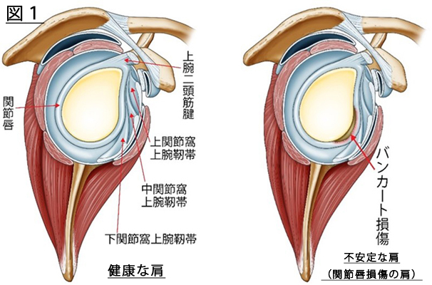 健康な肩と不安定な肩の比較