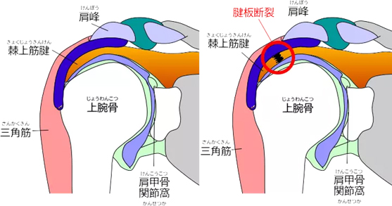 肩腱板断裂・腱板損傷
