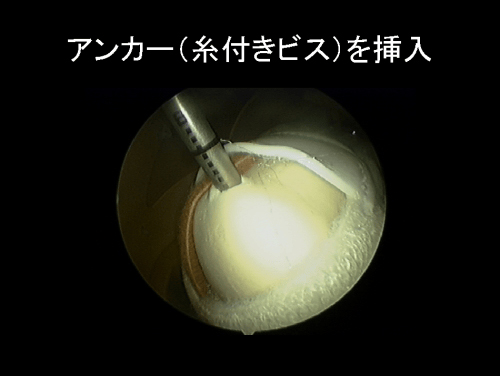 鏡視下腱板修復術-2