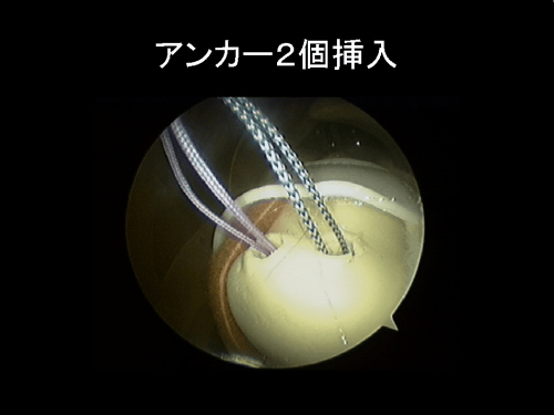 鏡視下腱板修復術-3