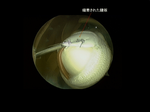 鏡視下腱板修復術-7