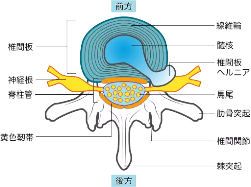 腰椎椎間板ヘルニア