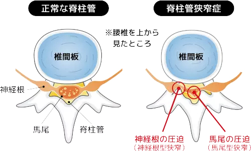 腰部脊柱管狭窄症
