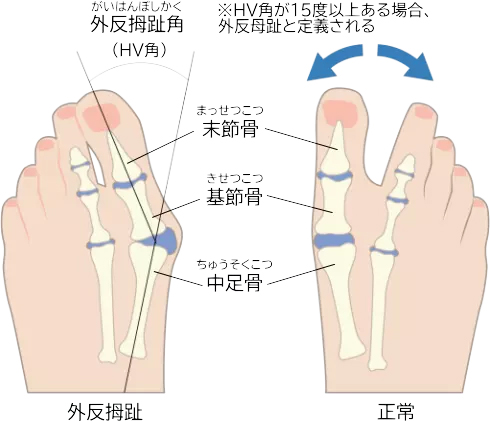外反母趾