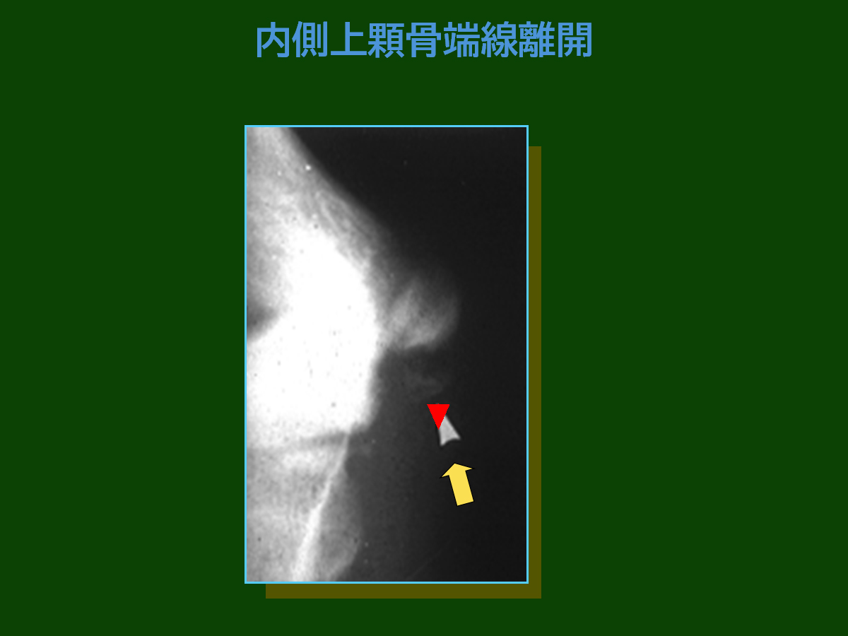 内側上顆骨端線離開