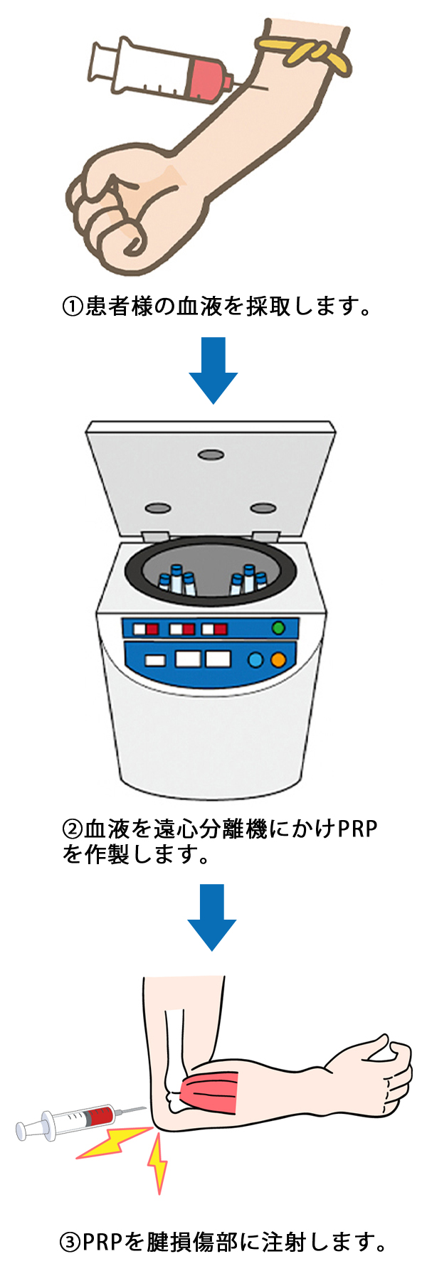 PRP治療の流れ