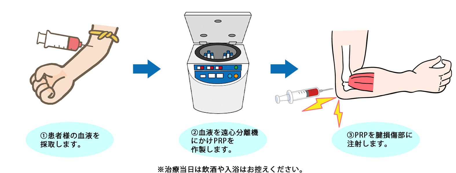 PRP治療の流れ